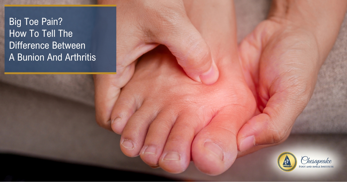 Big Toe Pain? How To Tell The Difference Between A Bunion And Arthritis | Chesapeake Foot And Ankle Institute | Podiatrists in Vienna Virgina