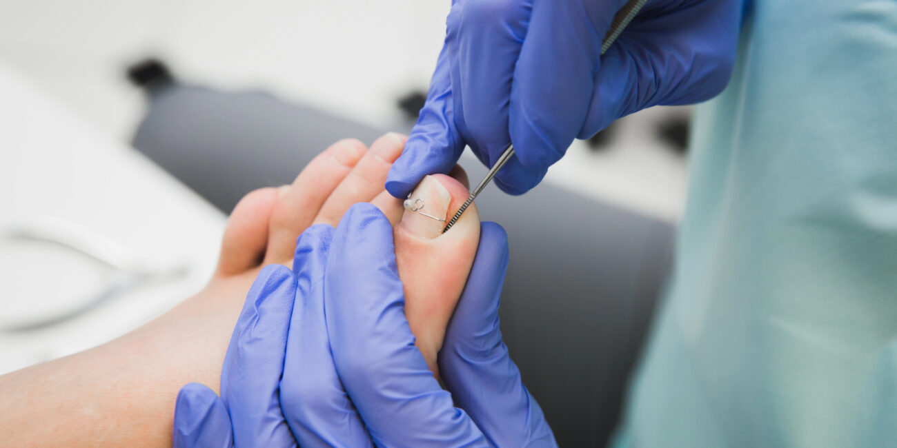 Podiatrist treating an ingrown toenail with medical instruments while wearing gloves. | Chesapeak Foot and Ankle Institute | Podiatrist in Vienna, VA